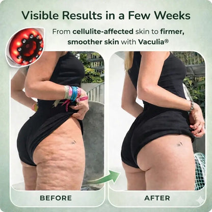 Vaculia™ Anti-Cellulite Massager