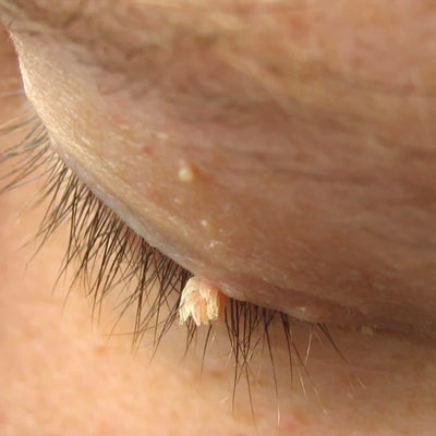 Filiform Skin Tag